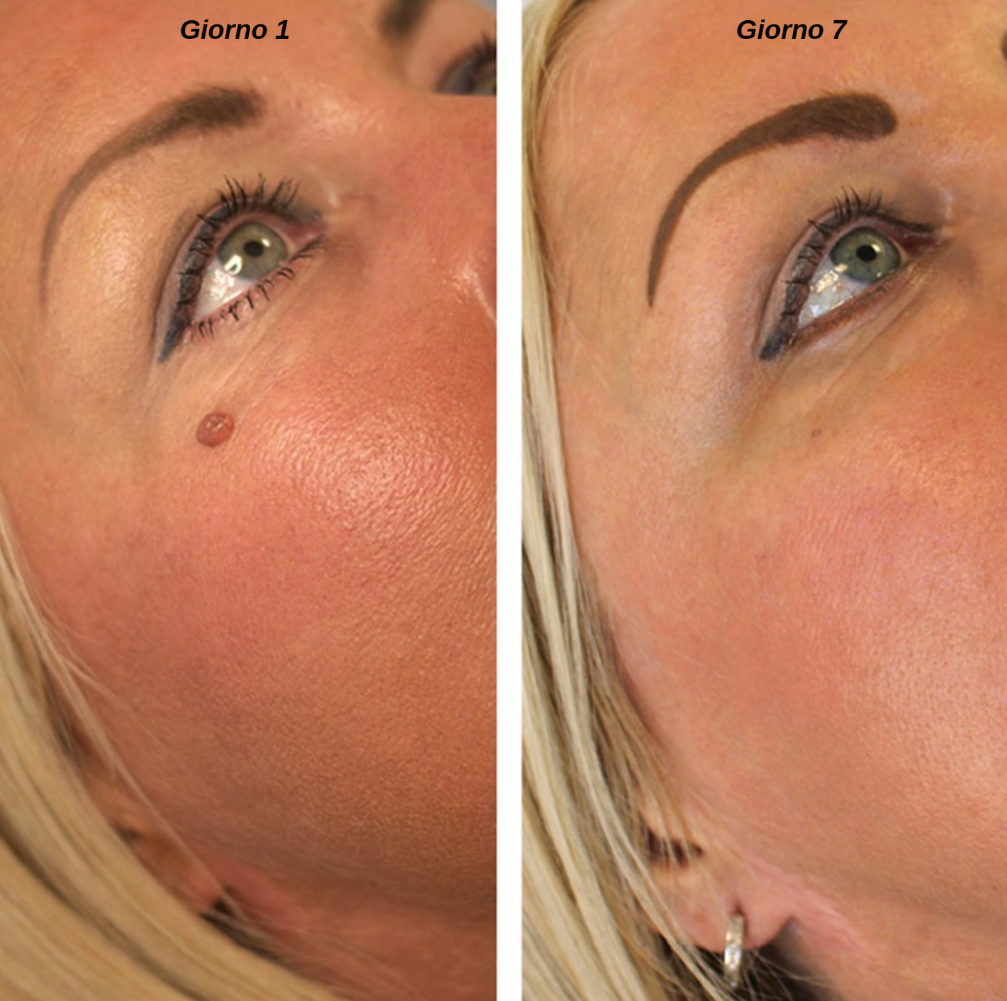 Leviora™ - Kit completo rimozione escrescenze cutanee