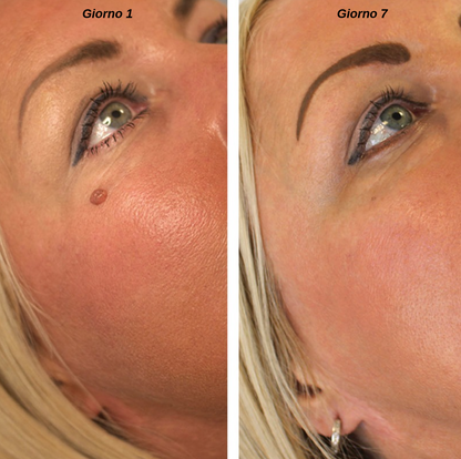 Leviora™ - Kit completo rimozione escrescenze cutanee