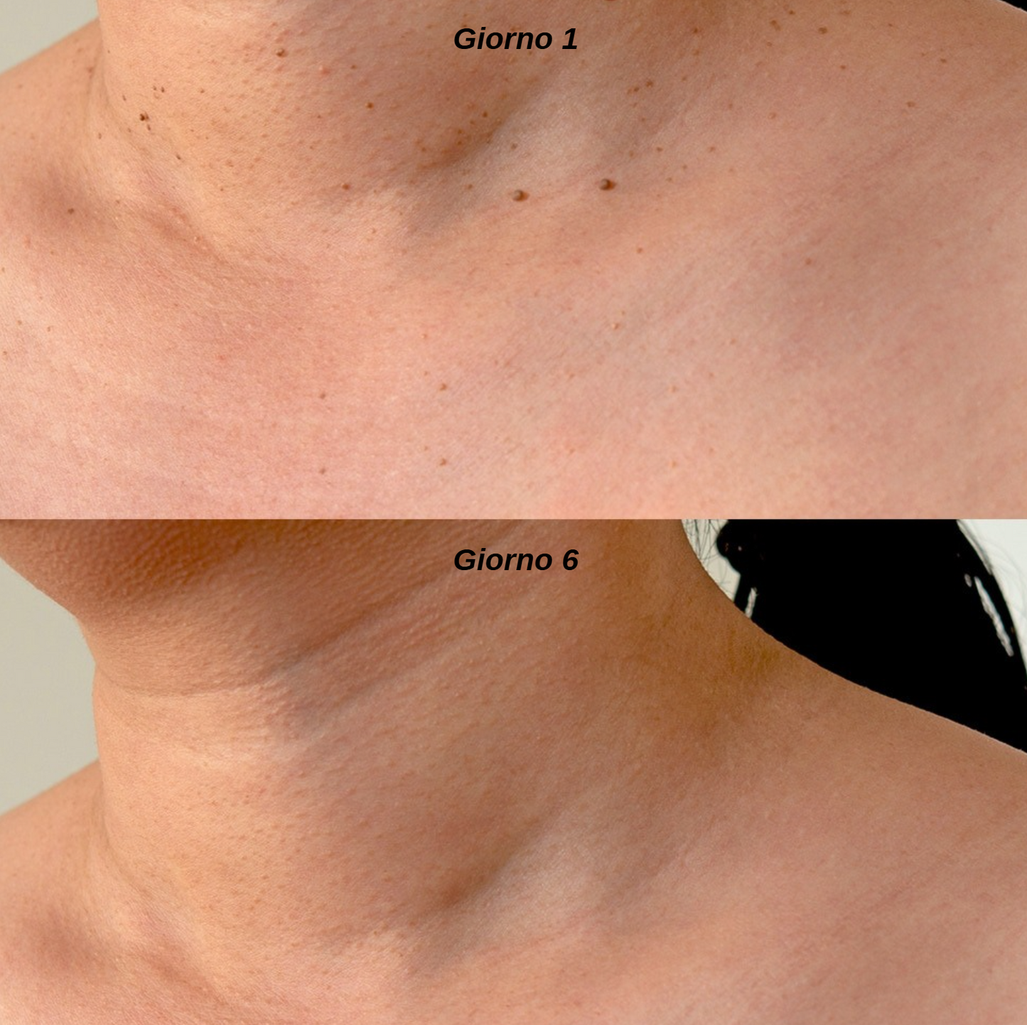 Leviora™ - Kit completo rimozione escrescenze cutanee