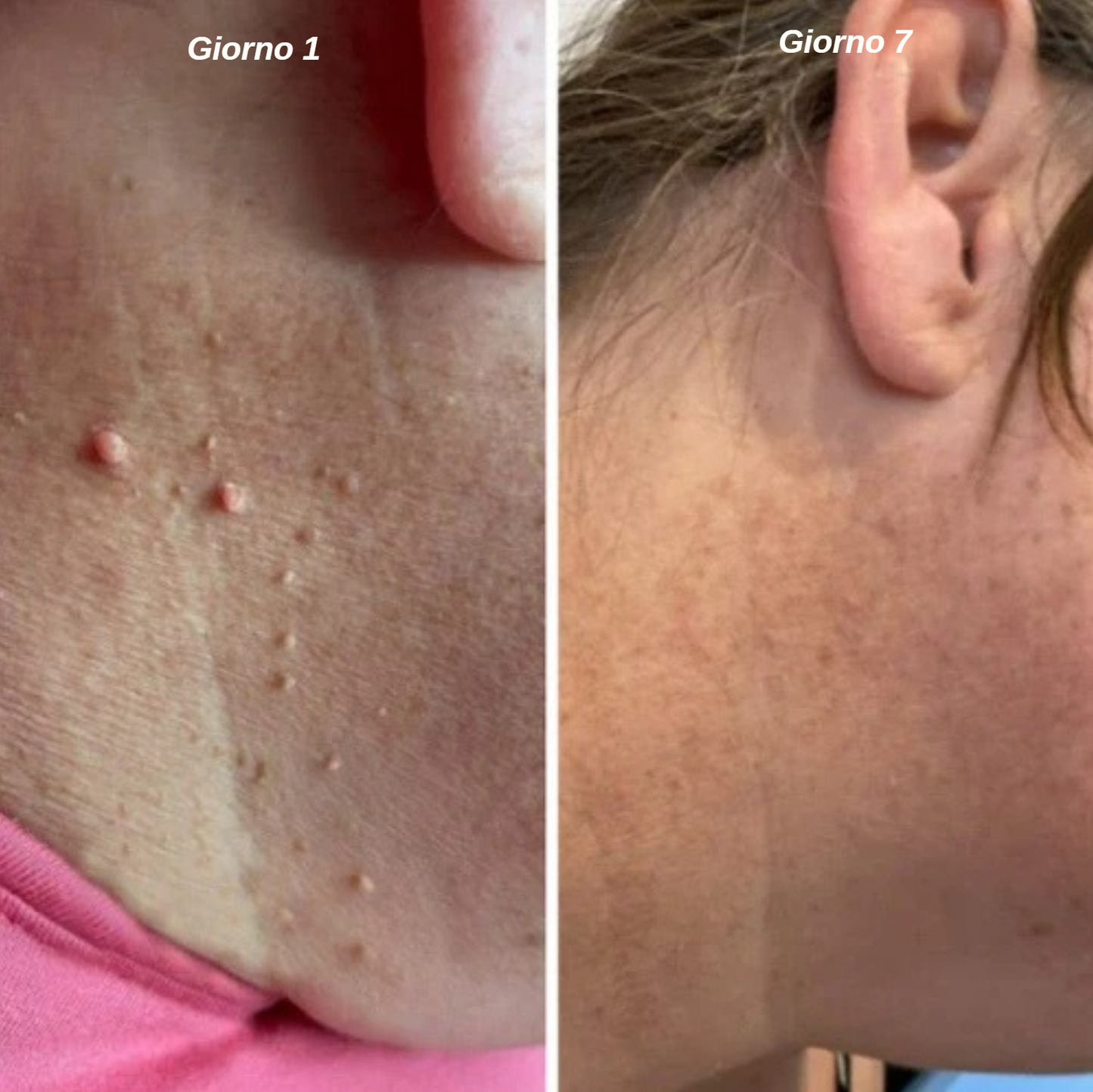 Leviora™ - Kit completo rimozione escrescenze cutanee